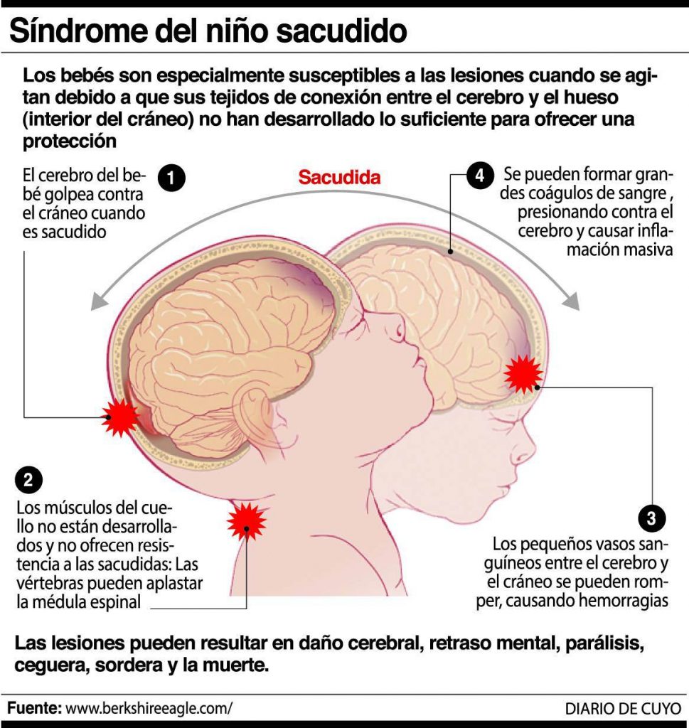 Sindrome niño sacudido 2