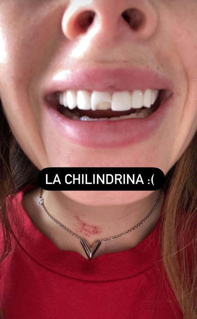 ignacia michelson se rompió su dentadura 