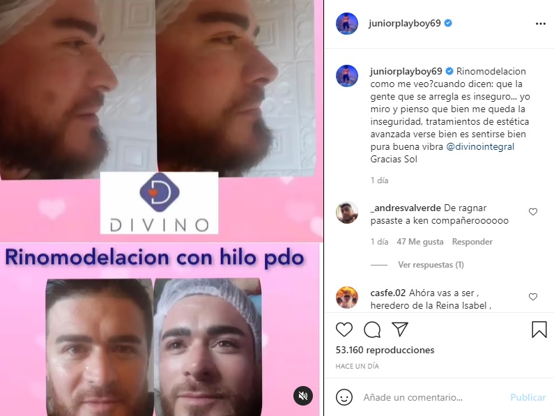 Junior Playboy Se Hizo Un Retoque En Su Nariz